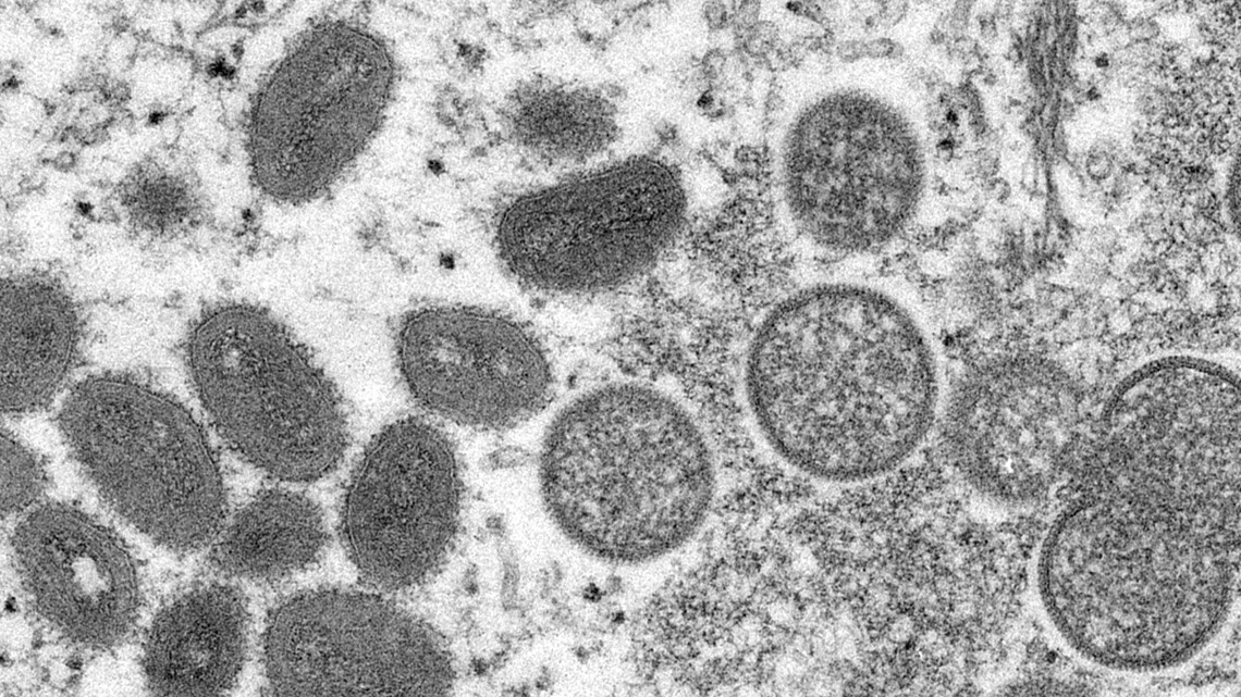 Monekypox bukan darurat kesehatan global, kata WHO