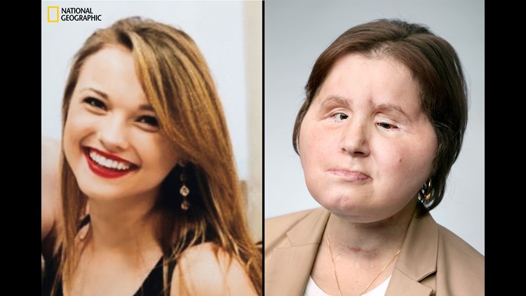 21-year-old receives historic face transplant