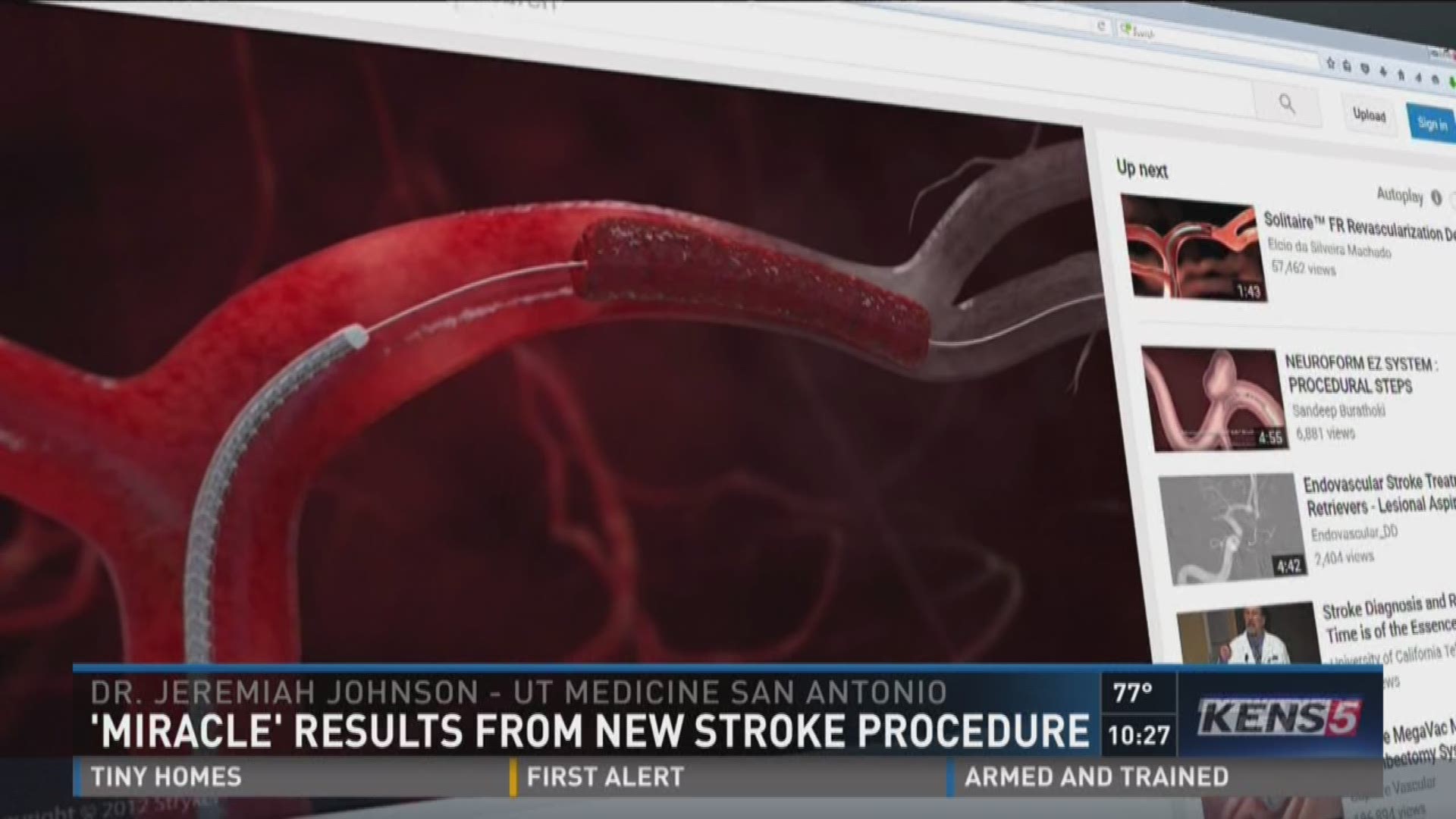'Miracle' results from new stroke procedure