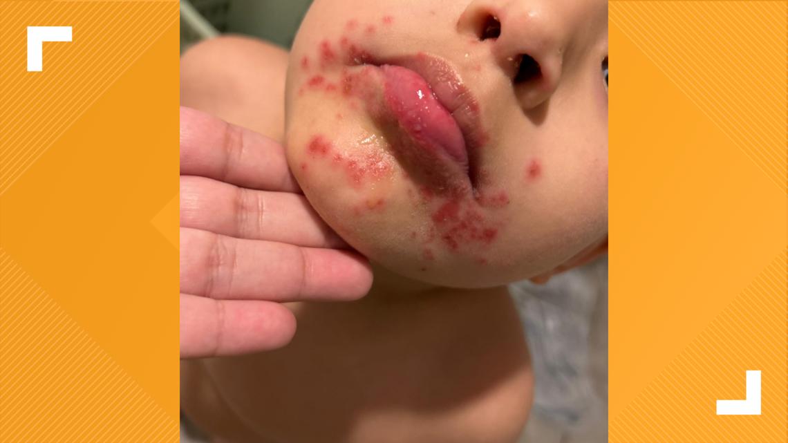 Mother wants to raise awareness after son contracts hand, foot and mouth disease at local park
