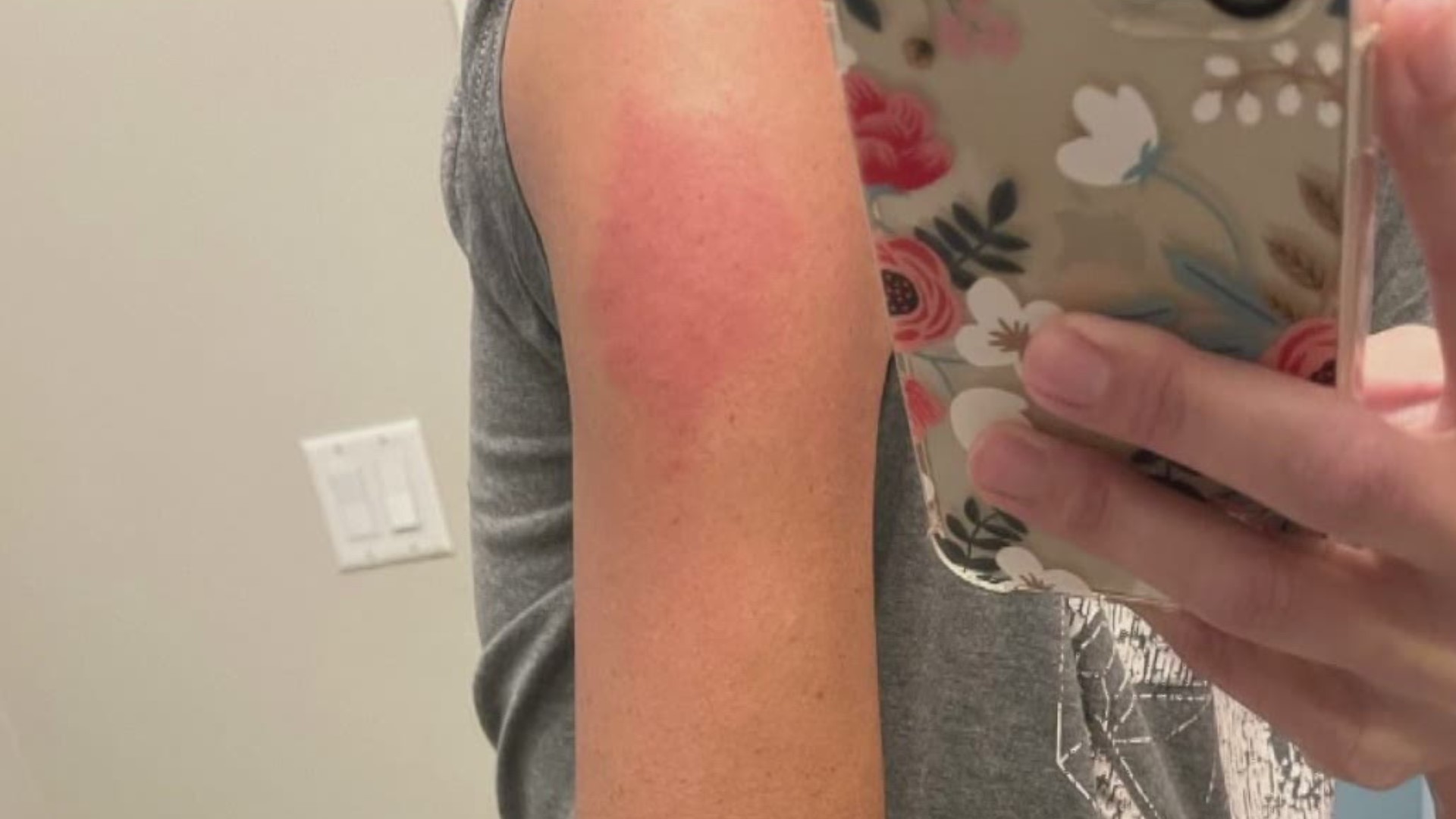 COVID Arm Vaccine Side Effect Is Swollen Red Arm Around Shot Khou