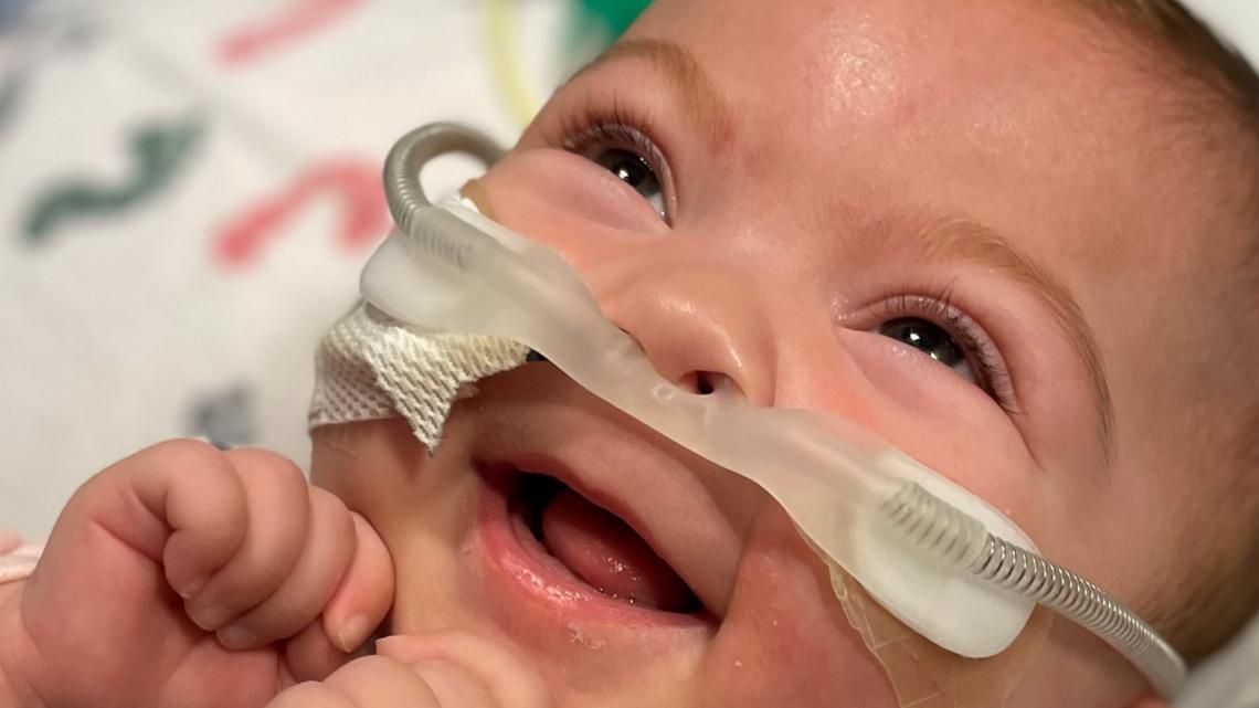 Gadis kembar dengan 1 paru-paru pulang dari Rumah Sakit Anak Rady