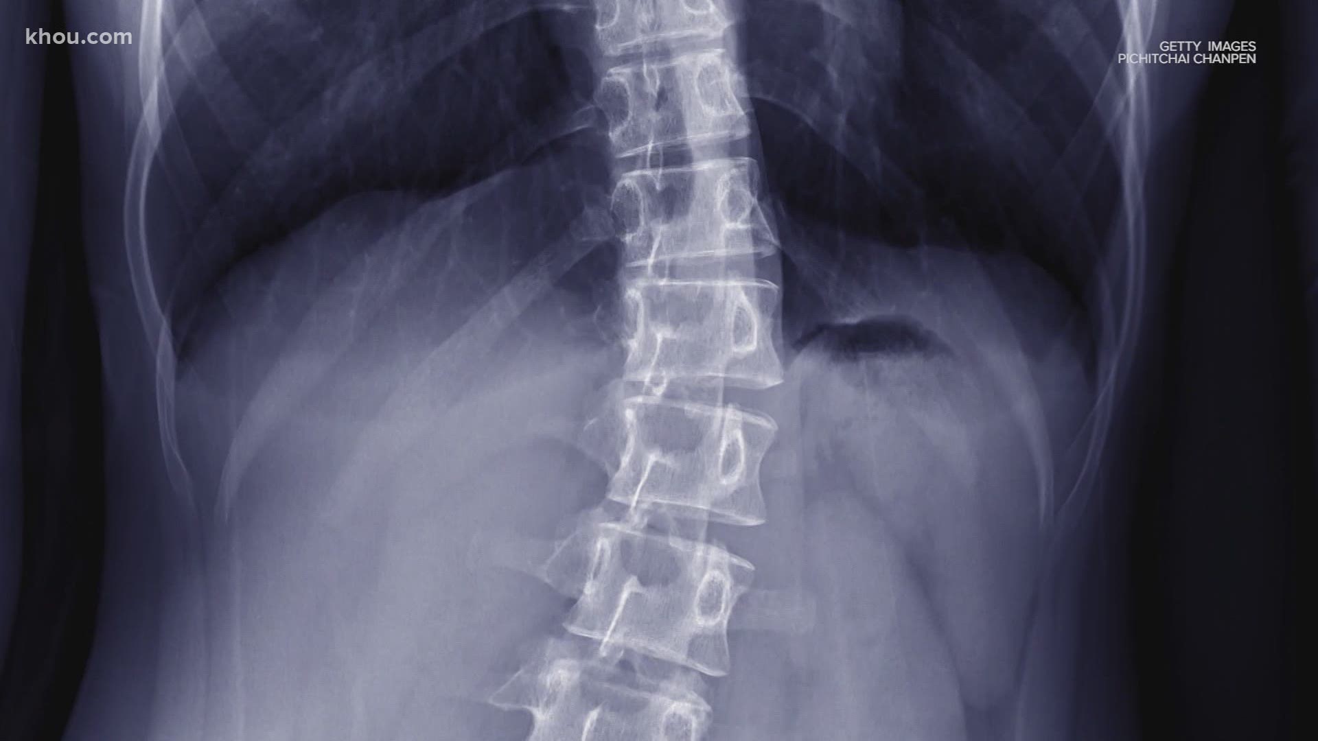 Scoliosis affects 2 to 3 percent of the population, but it's typically evident in children 10-15. Doctors with UT Physicians have a unique range of care for patients