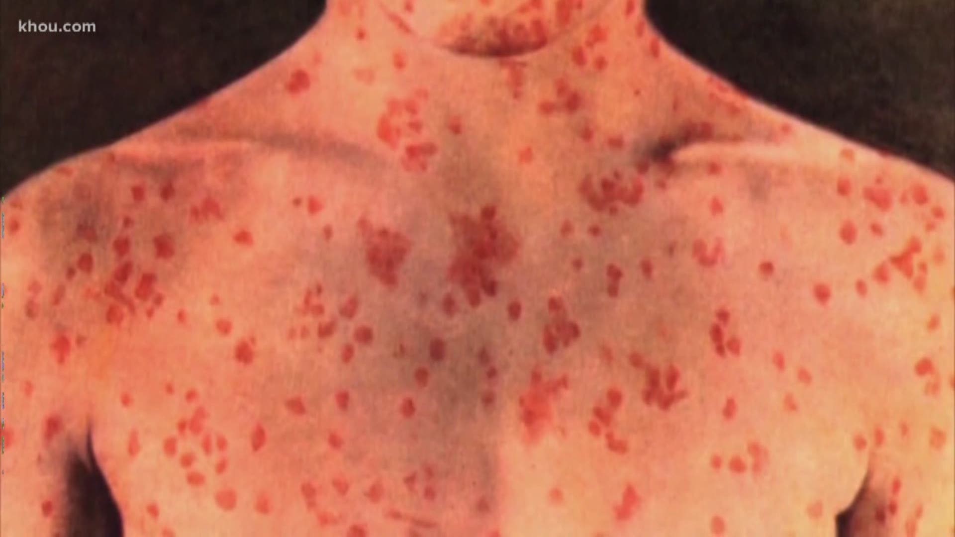 Health officials say the one measles case in Galveston County might be connected to the cases in Harris County.