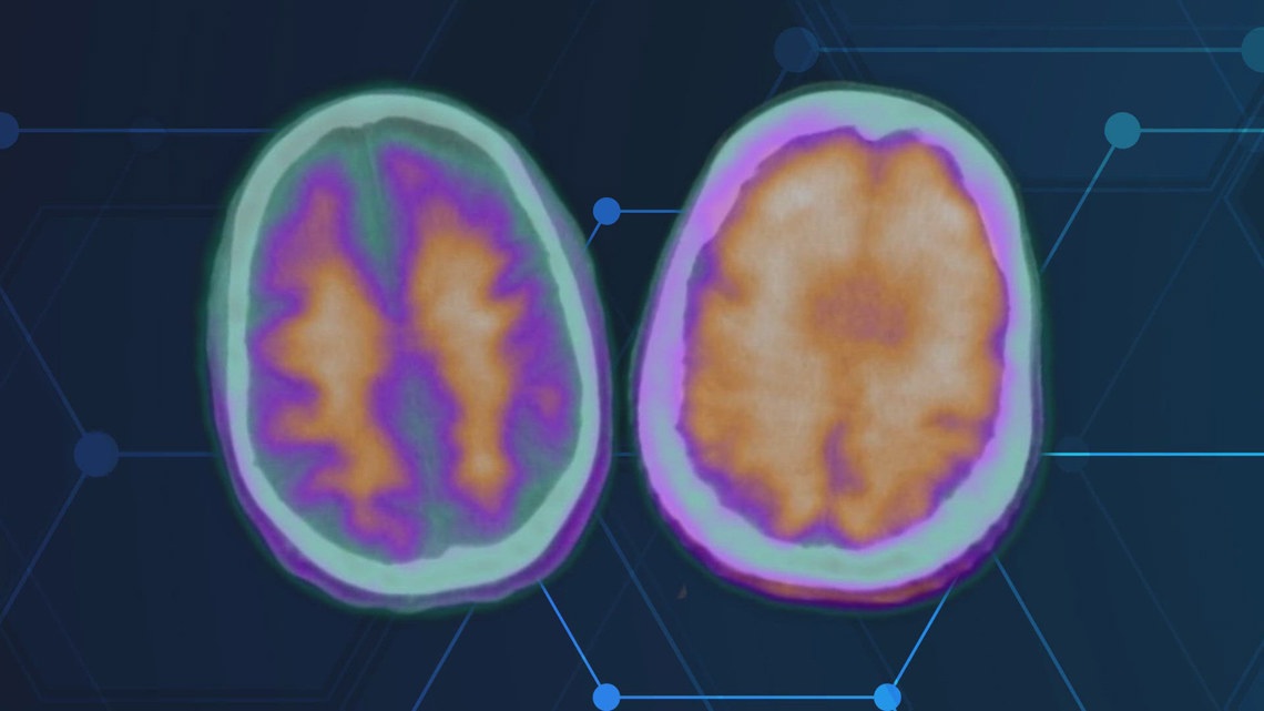 Health Matters: UT Health neurologist leads groundbreaking Alzheimer's drug trial