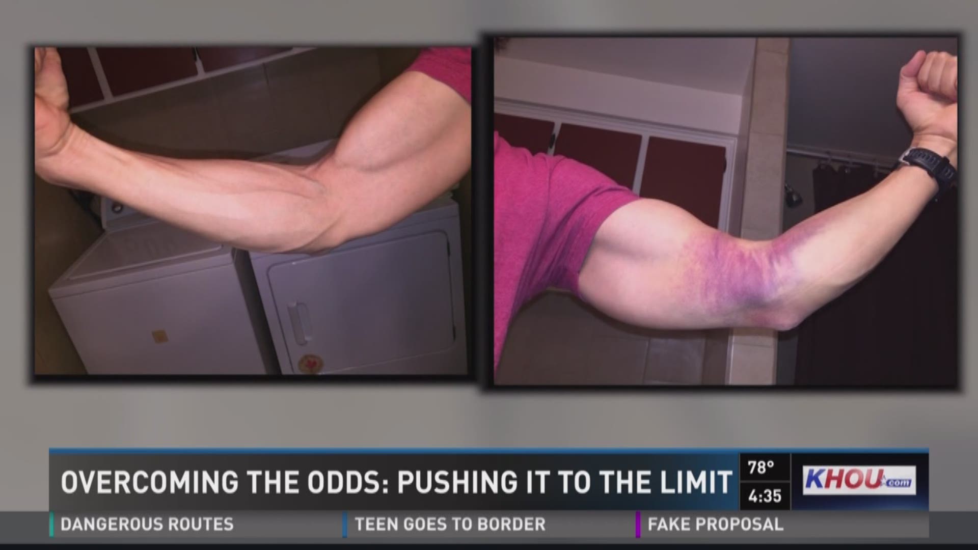 After tearing his bicep and undergoing surgery, a Houston man recovered quickly and plans to compete in the Ironman challenge.