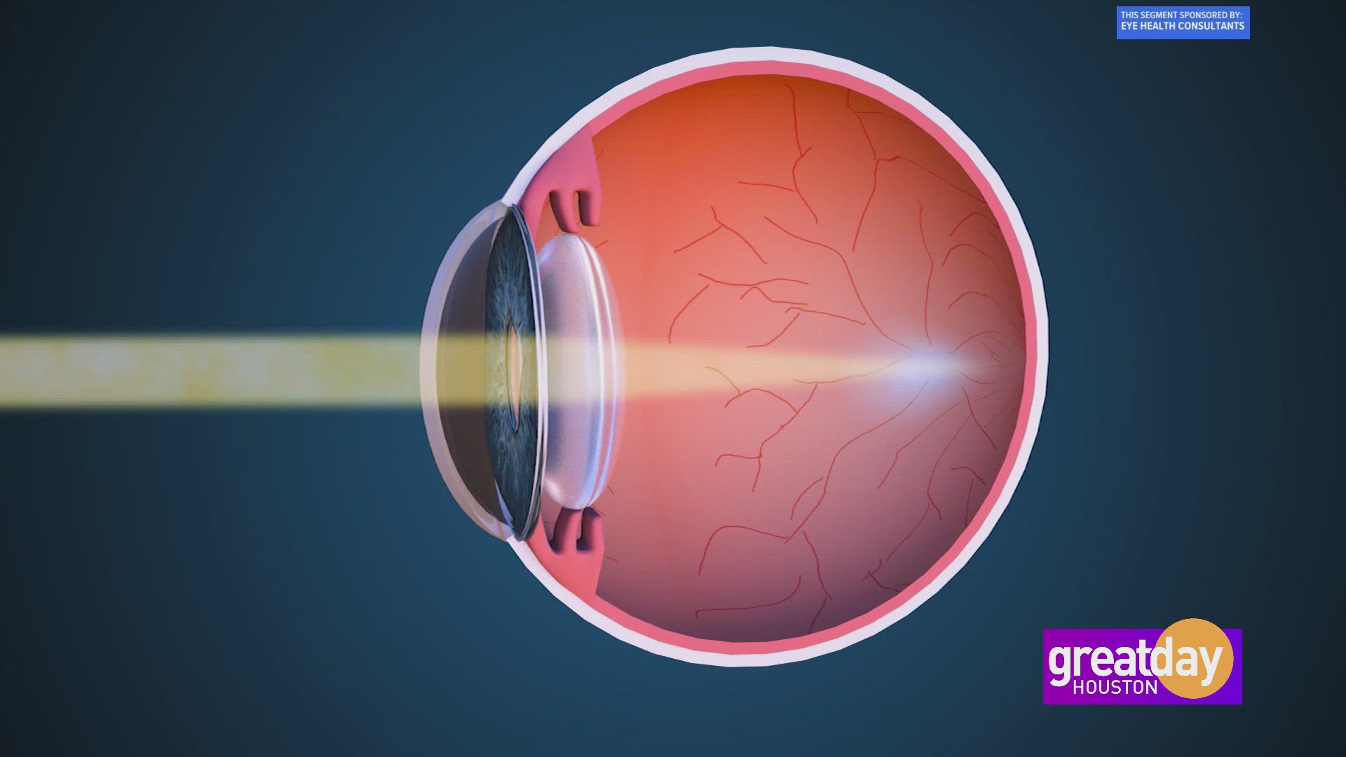 Dr. Julio Arroyo from Eye Health Consultants explains how corneal molding helps patients see clearly without glasses, daily contacts or surgery.