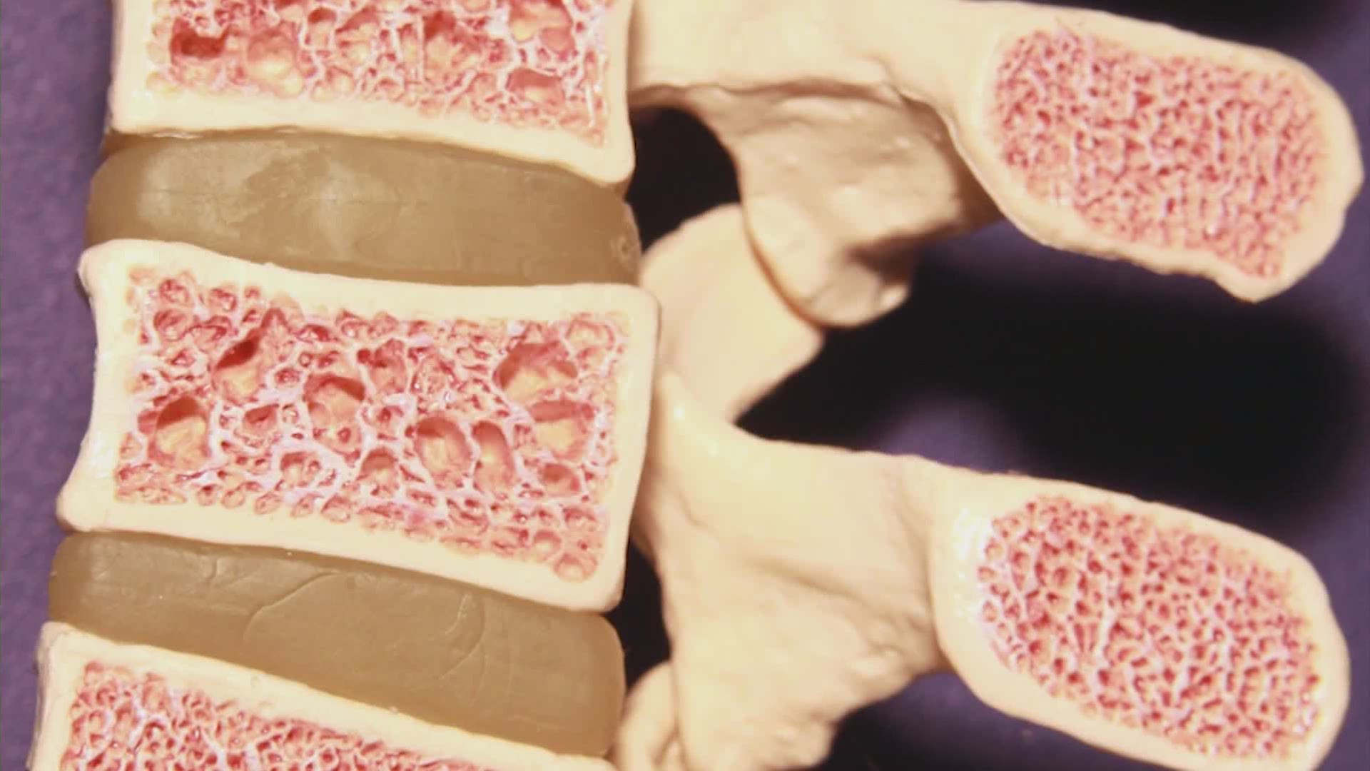 Building up your bone health now plays a key role in preventing osteoporosis later. Dr. Nahid Rianon with UT Physicians explains.