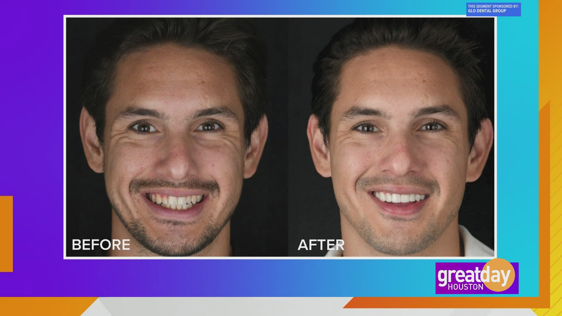 For years, Alex Garcia hid his teeth in photos and selfies. Thanks to Dr. Mikenah Joy Vega at Glo Dental Group, he now smiles with confidence.