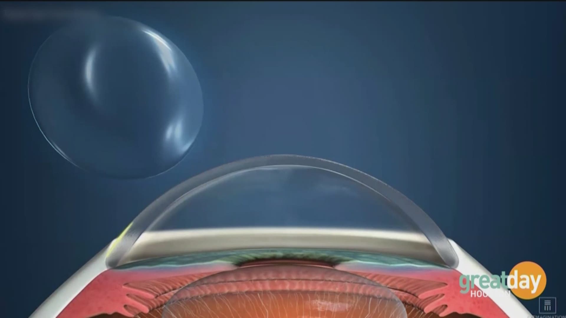 Dr. Arroyo with Eye Health Consultants details how Corneal Molding can