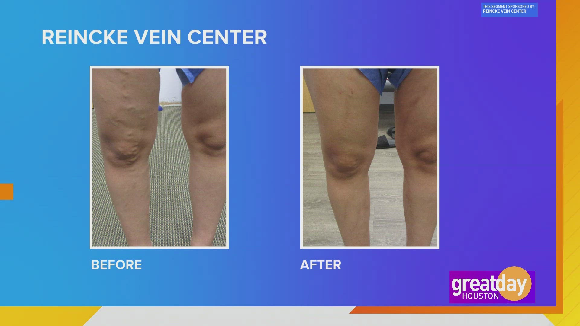 Minimally invasive, non-surgical vein treatments that help get patients back on their feet in no-time!