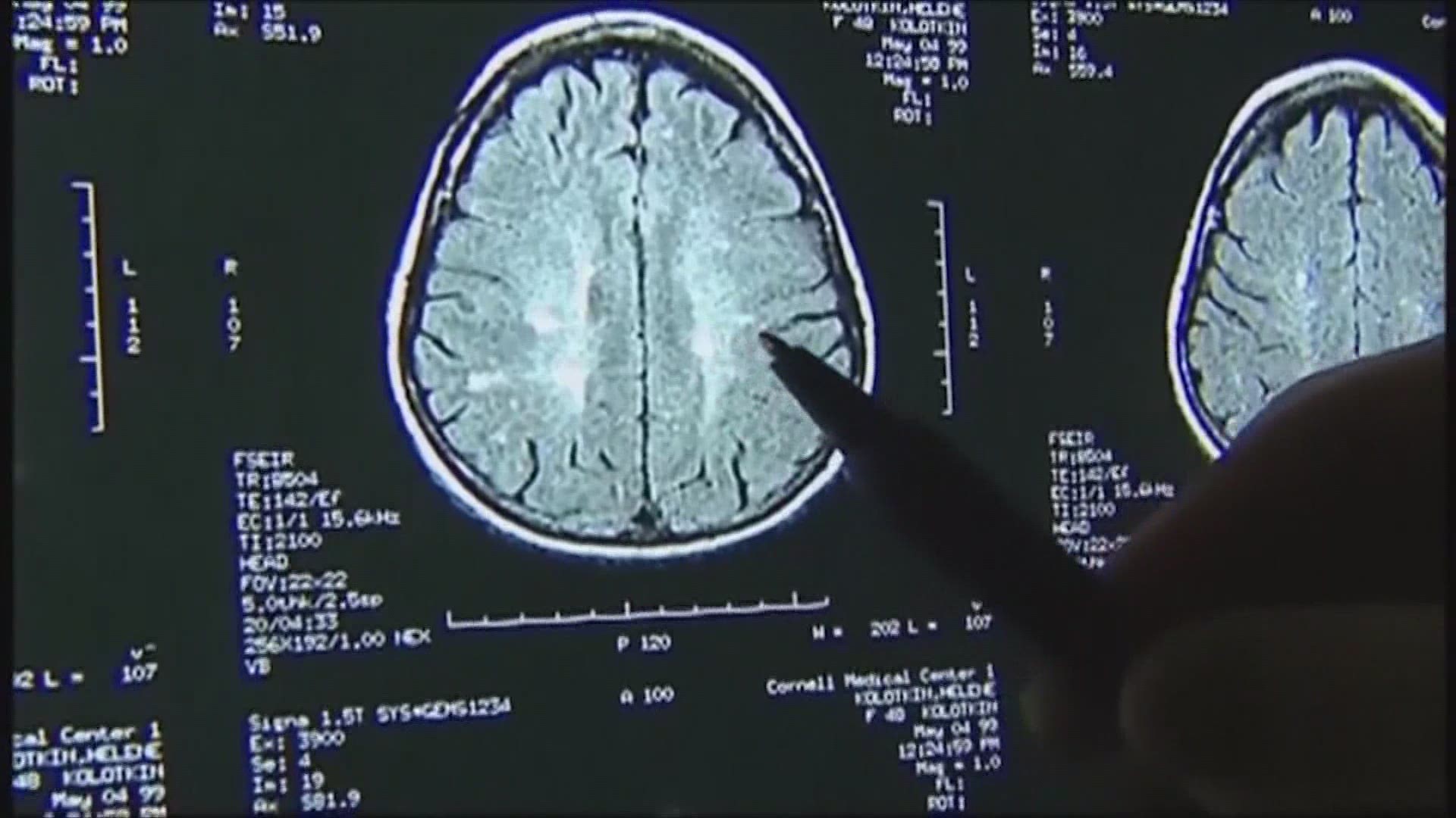 Brain scans of people who recovered from COVID-19 had more brain atrophy in parts of the brain that control taste, smell, and memory.