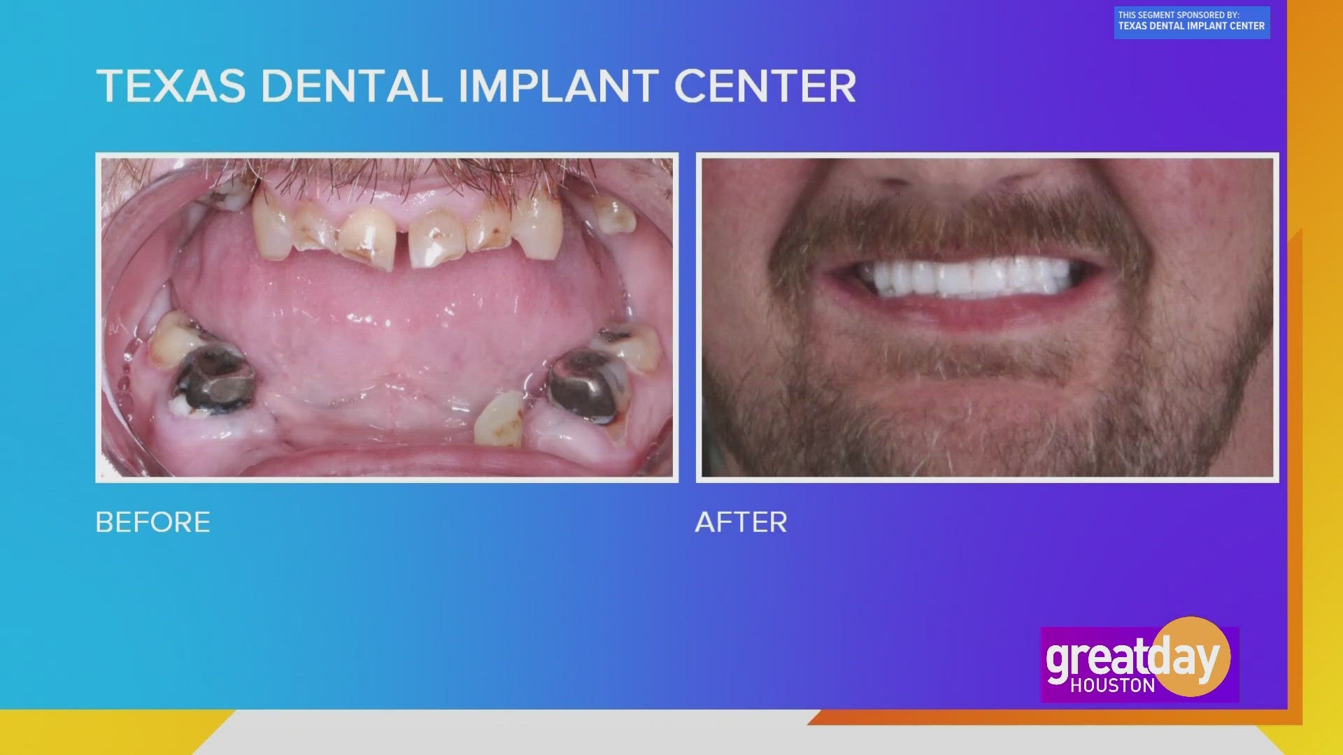 Many people experience missing or broken teeth as they age. A trip to Texas Dental Implant Center can help transform your smile... for good!