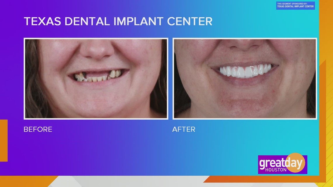 Ucapkan selamat tinggal pada komplikasi gigi dengan bantuan dari Texas Dental Implant Center