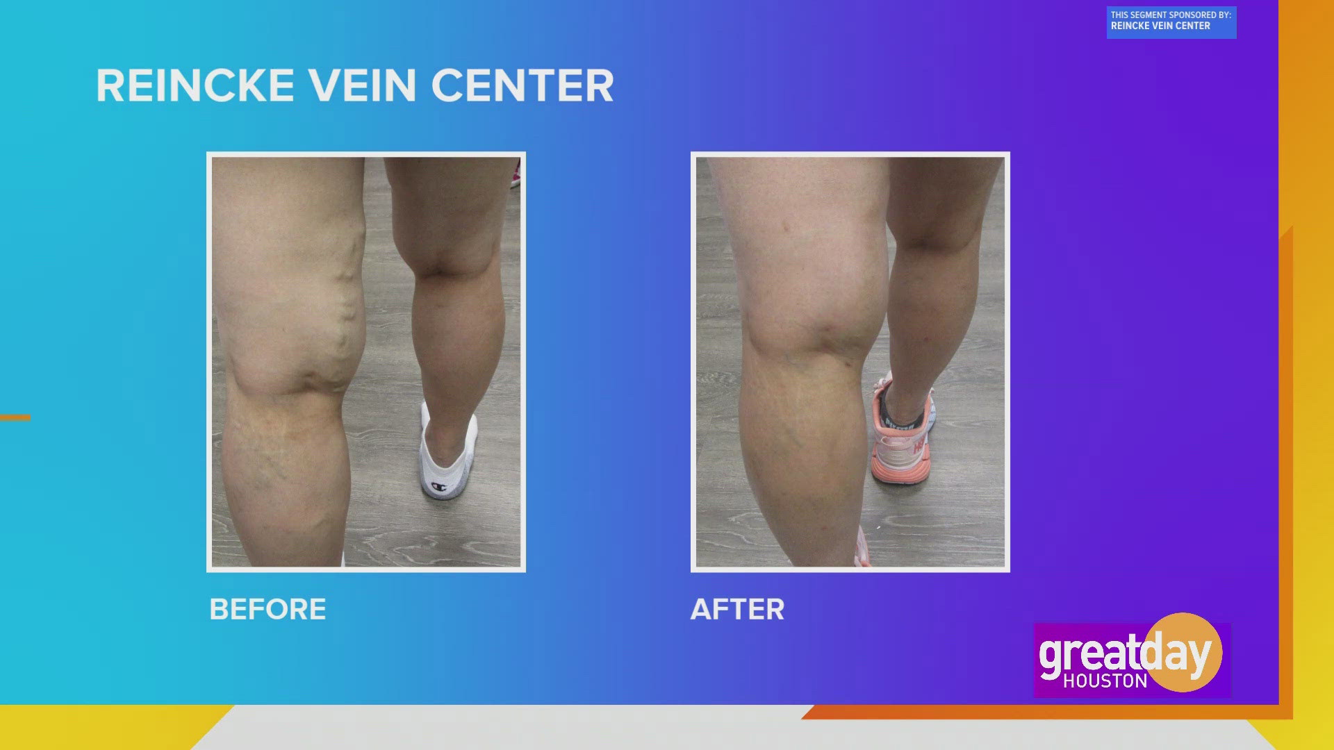 Minimally invasive, non-surgical vein treatments that help get patients back on their feet in no-time!