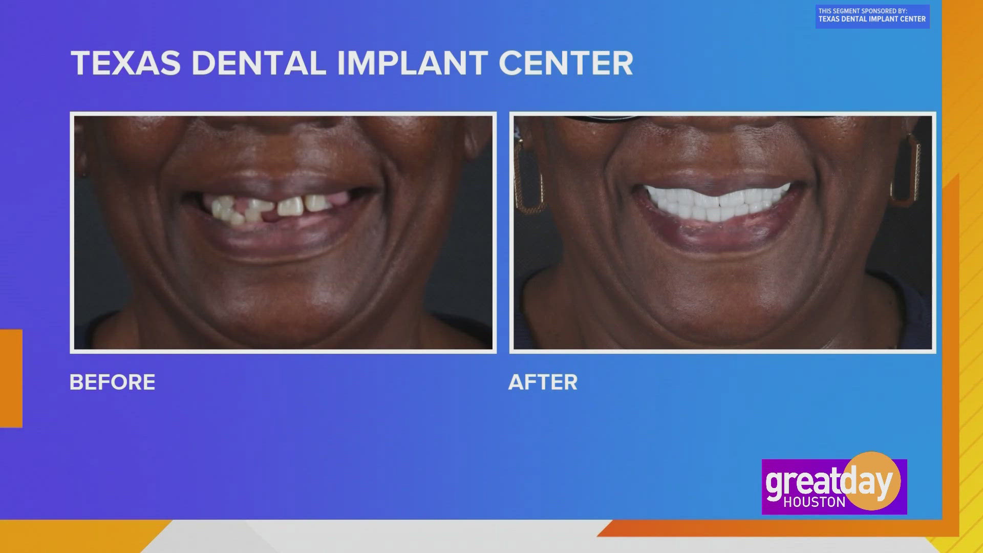 Many people hide behind their smile, but you don't have to be one of them. Texas Dental Implant Center can give you the smile of your dreams.