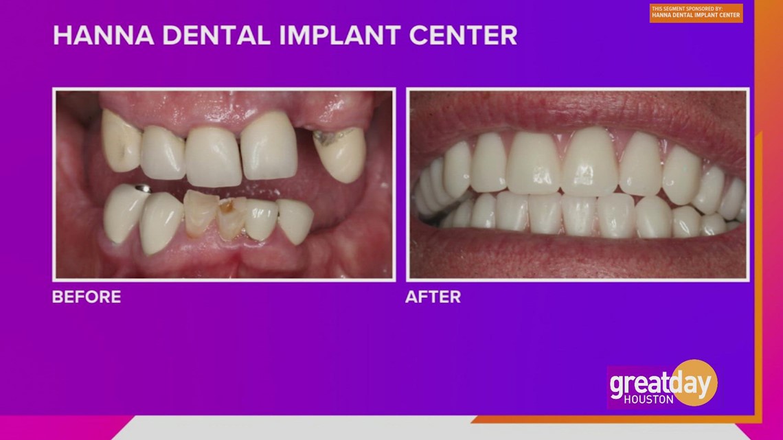 Hanna Dental Implant Center gave Steve the freedom to smile again