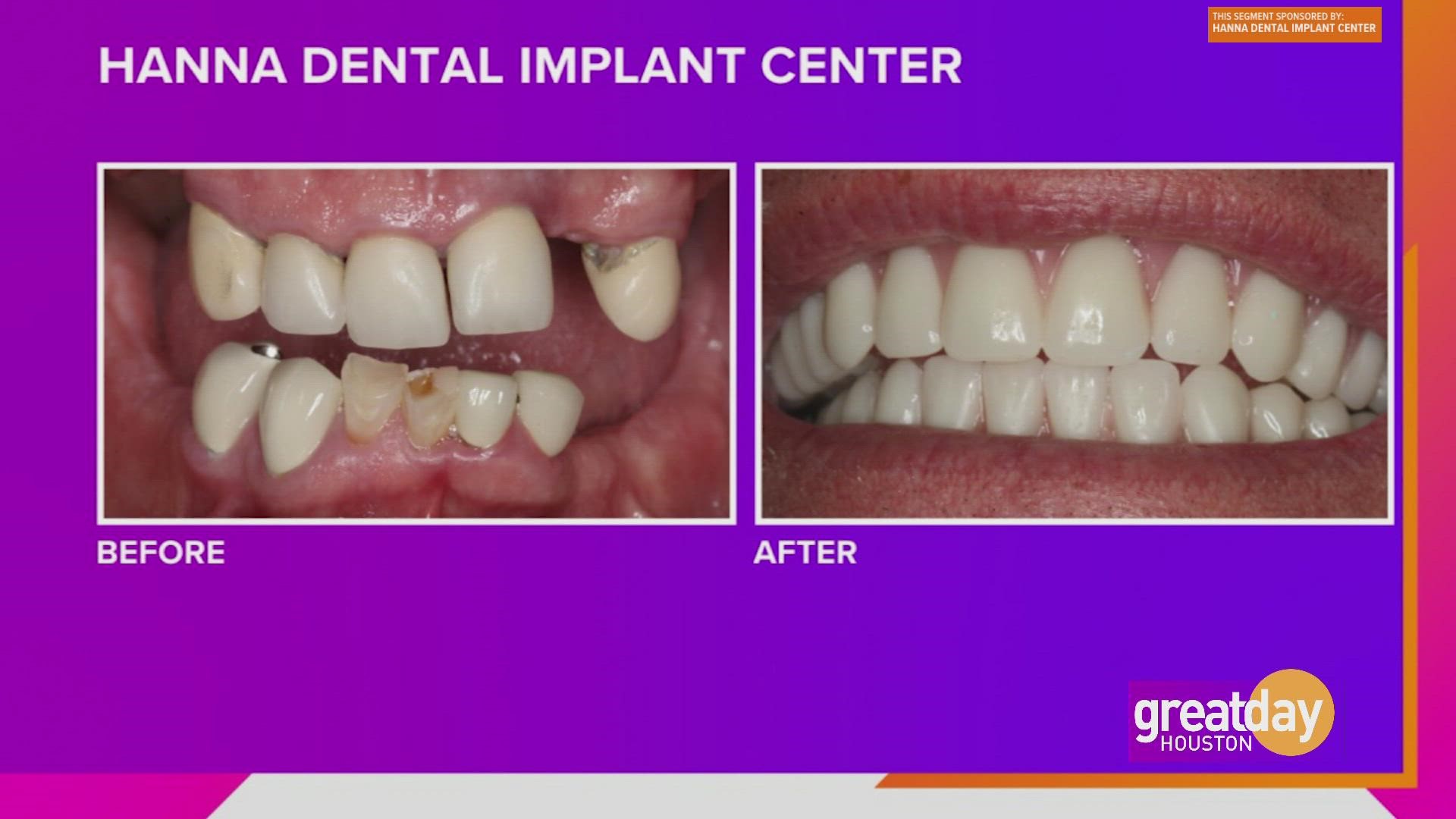Makeover your smile with Dr. Raouf Hanna of Hanna Dental Implant Center