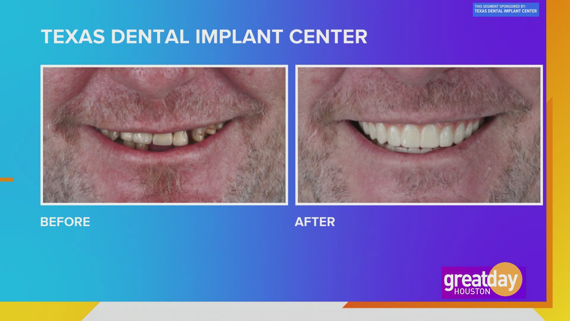 Let the Texas Dental Implant Center can give you the smile and confidence of your dreams.