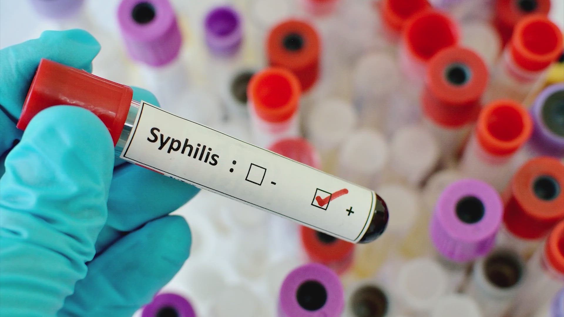 Congenital syphilis is when an unborn mother with syphilis passes the infection on to her baby during pregnancy. In Houston, congenital syphilis rose drastically.