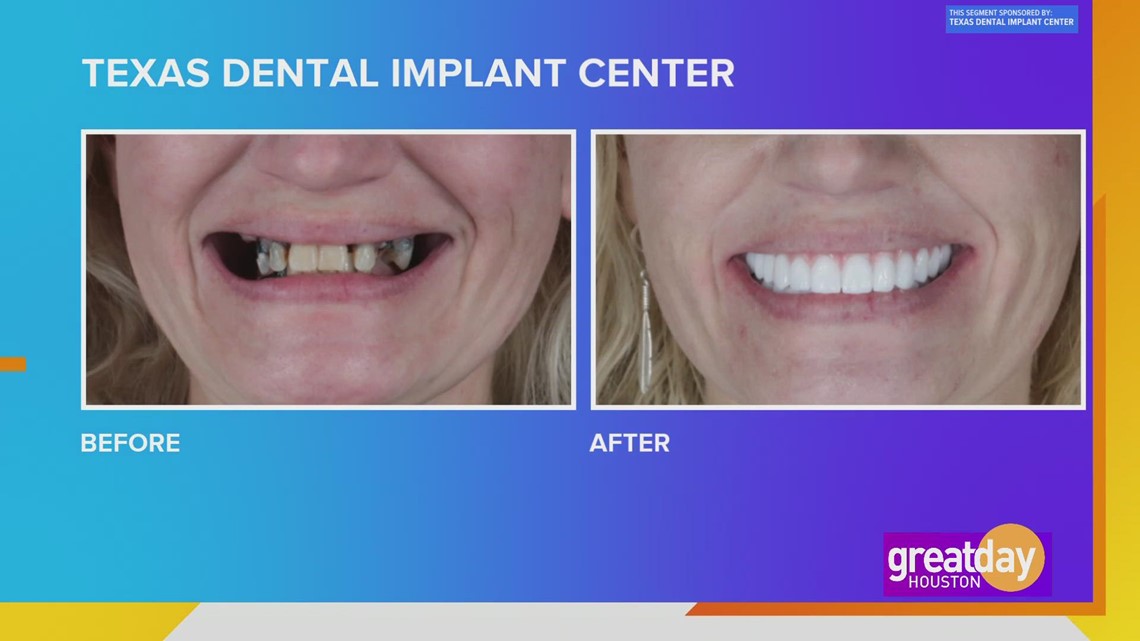 Memperbaiki gigi Anda dengan bantuan dari The Texas Dental Implant Center