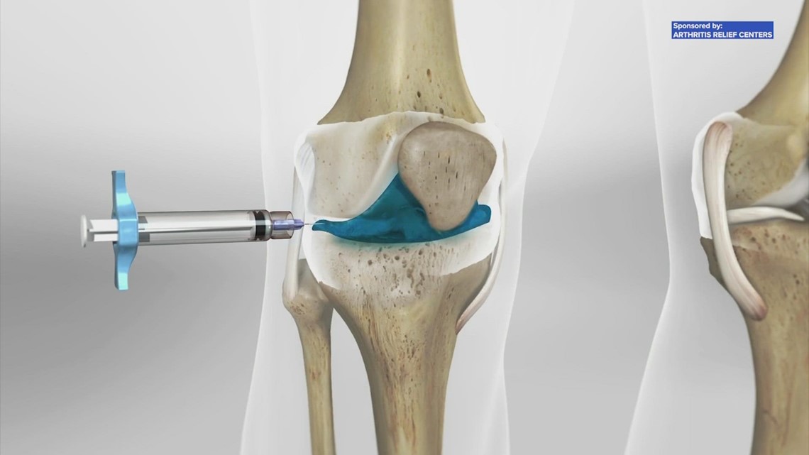 Cara menghilangkan sakit lutut tanpa operasi