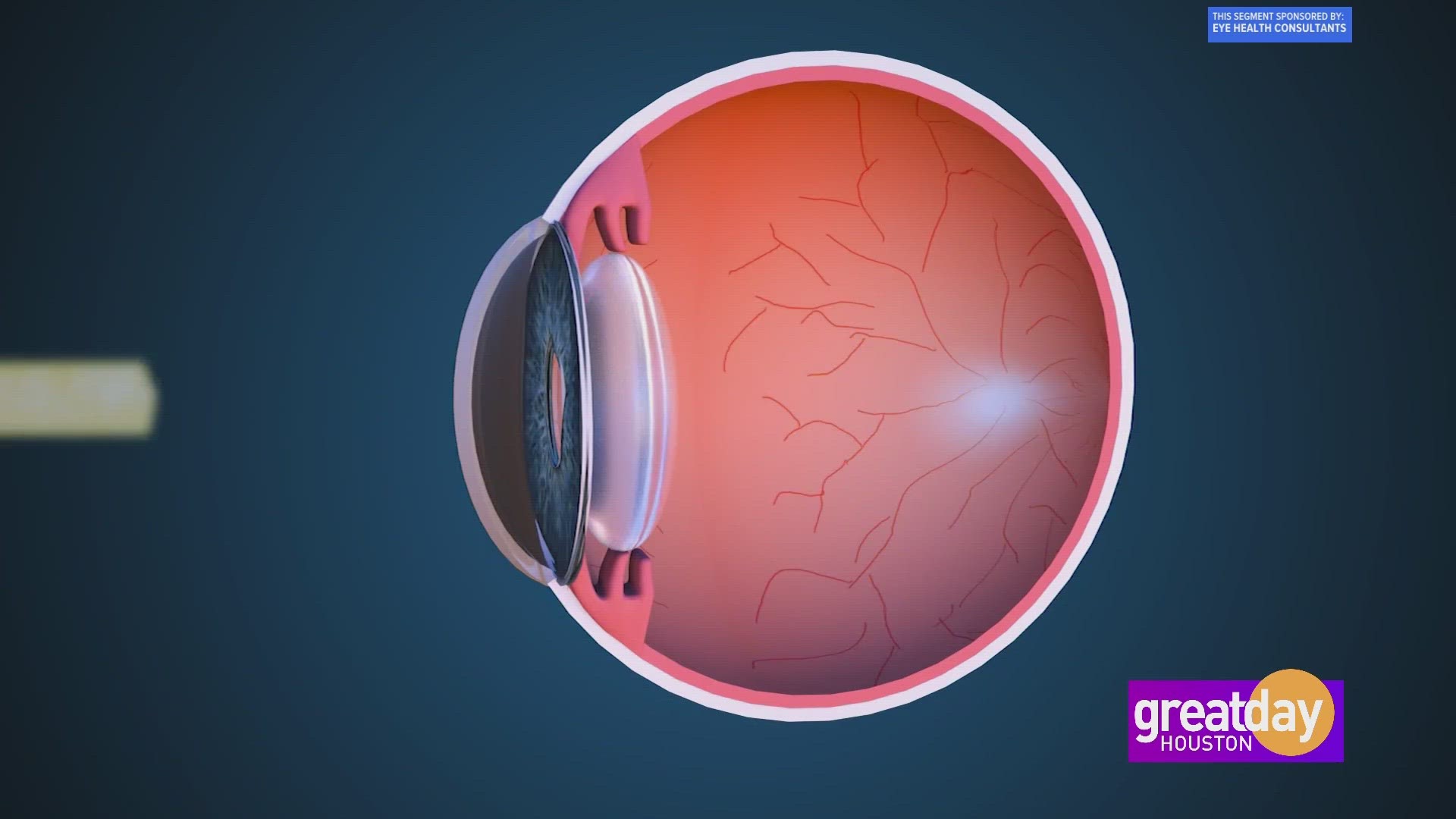 Sponsored Correct your vision while you sleep with corneal molding