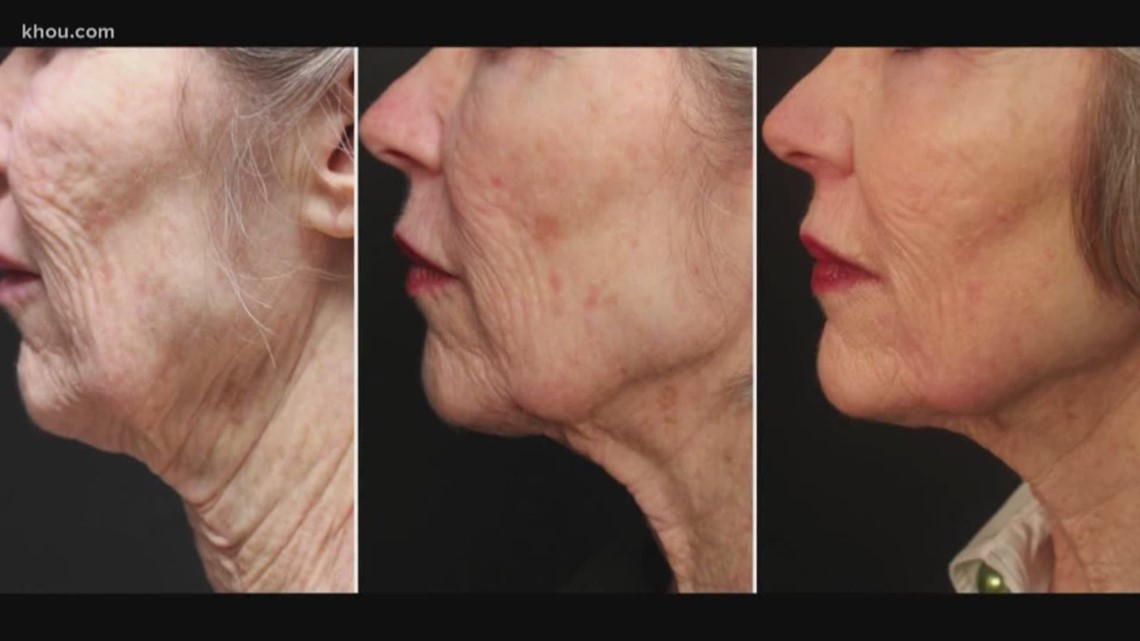Is it possible to get a face lift without going under the knife