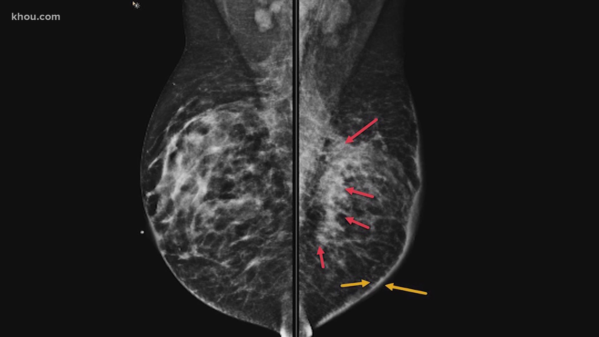 Inflammatory breast cancer is an aggressive form of cancer. Only one in two patients will live longer than five years.