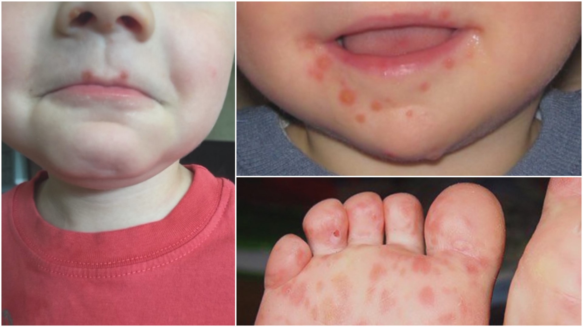 Highly contagious viral infection running rampant among San Antonio