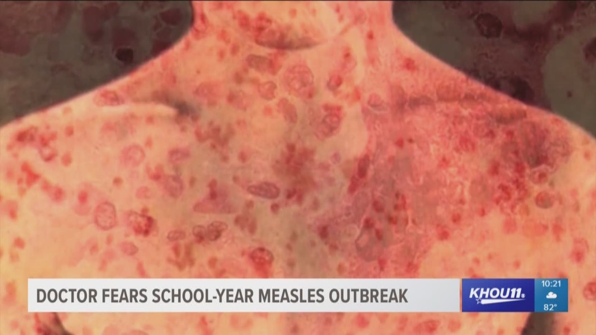 We look at why the number of people infected with measles is on the rise. One well-respected doctor tells why he thinks there could be an outbreak this upcoming school year.