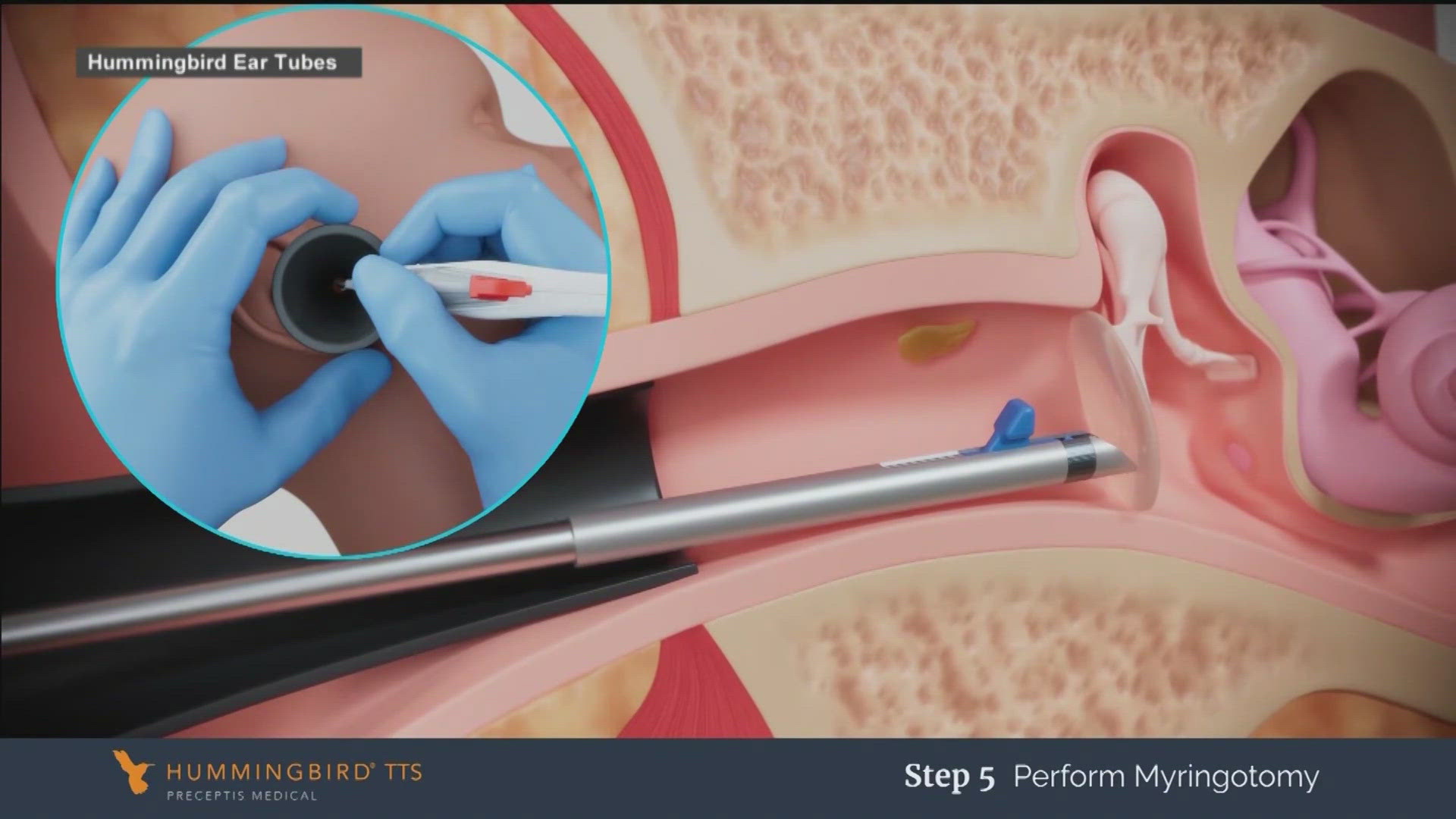The new device is changing care for children in need of ear tubes.
