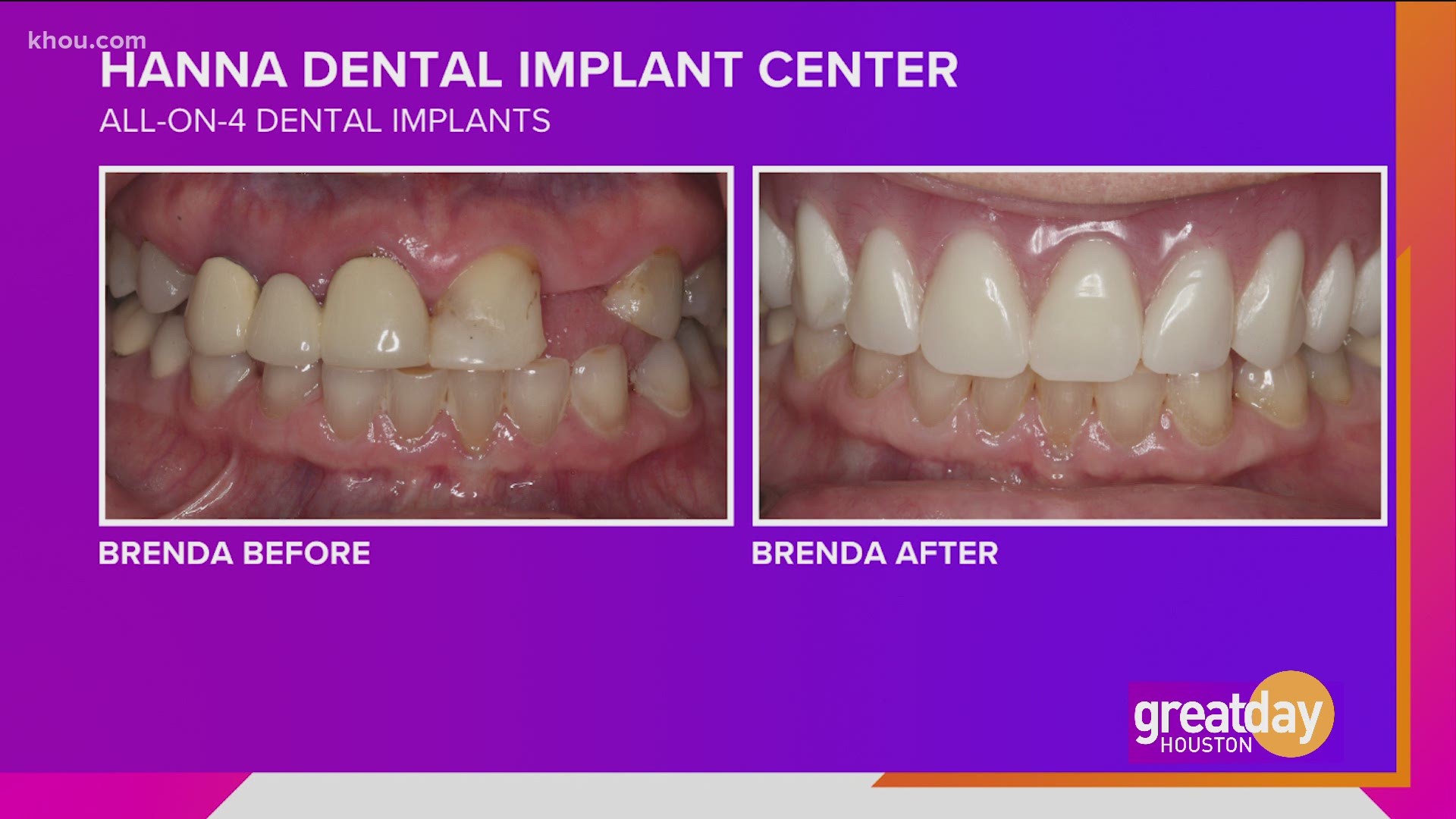 Dr. Raouf Hanna gave life-changing dental implants to Brenda Gibson through the Hanna Dental Implant Center