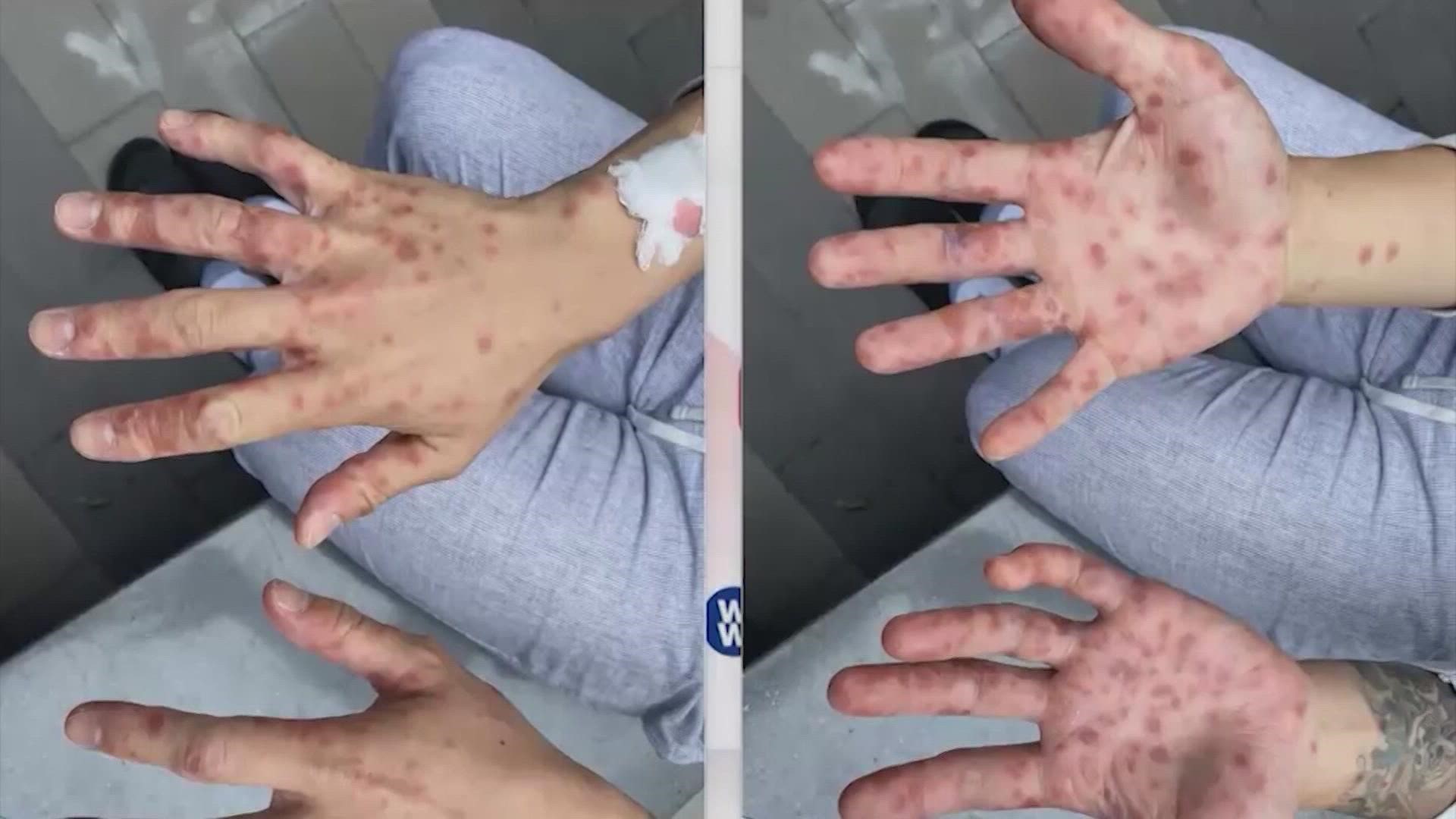 The CDC said it is doing a phased approach to the monkeypox vaccine allocation. It expects 1.9 million doses available through the rest of the year.