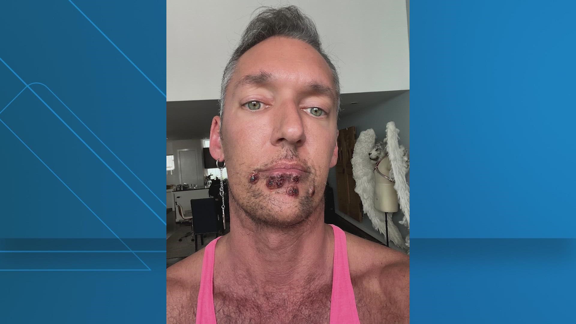 Houston man with monkeypox on face believes a kiss caused it