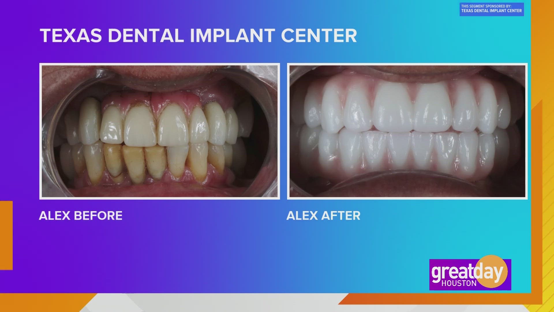 A new smile with help from Texas Dental Implant Center | khou.com