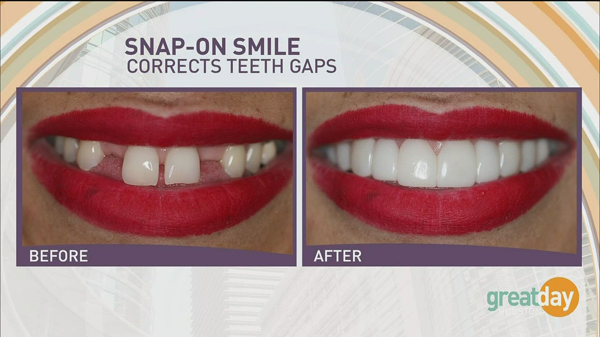 A Brand New Smile In A "Snap!"