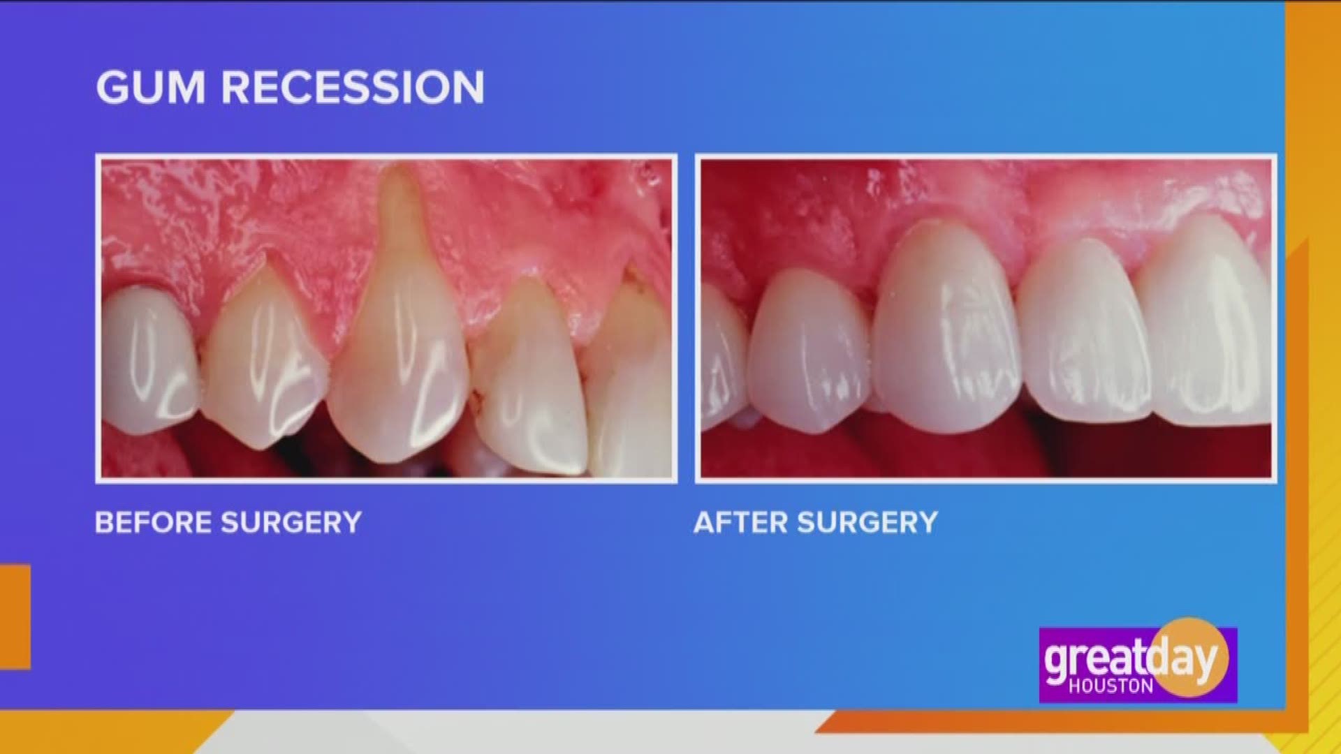 What causes gum recession? How can you stop it? Dr. Anna Munné has the answers.