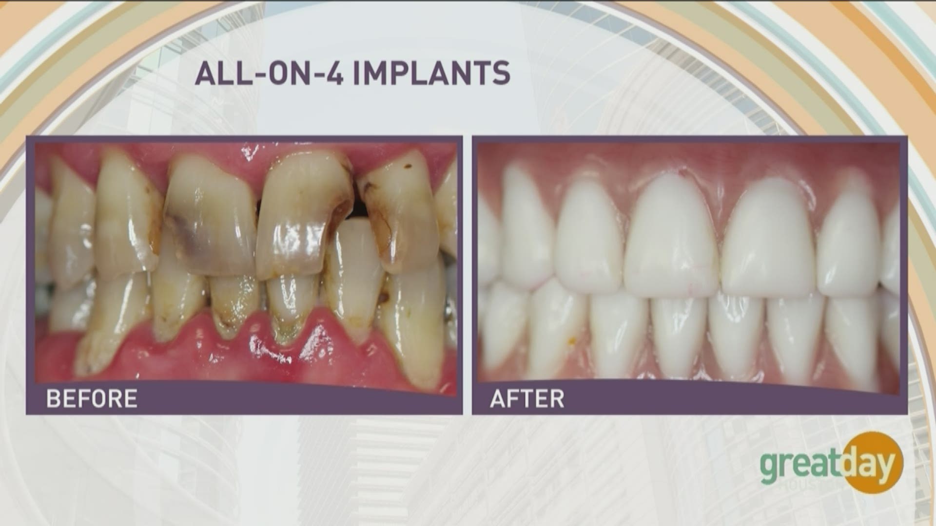 Periodontist Dr. Raouf Hanna has placed over 20,000 dental implants and wants to make you smile again.