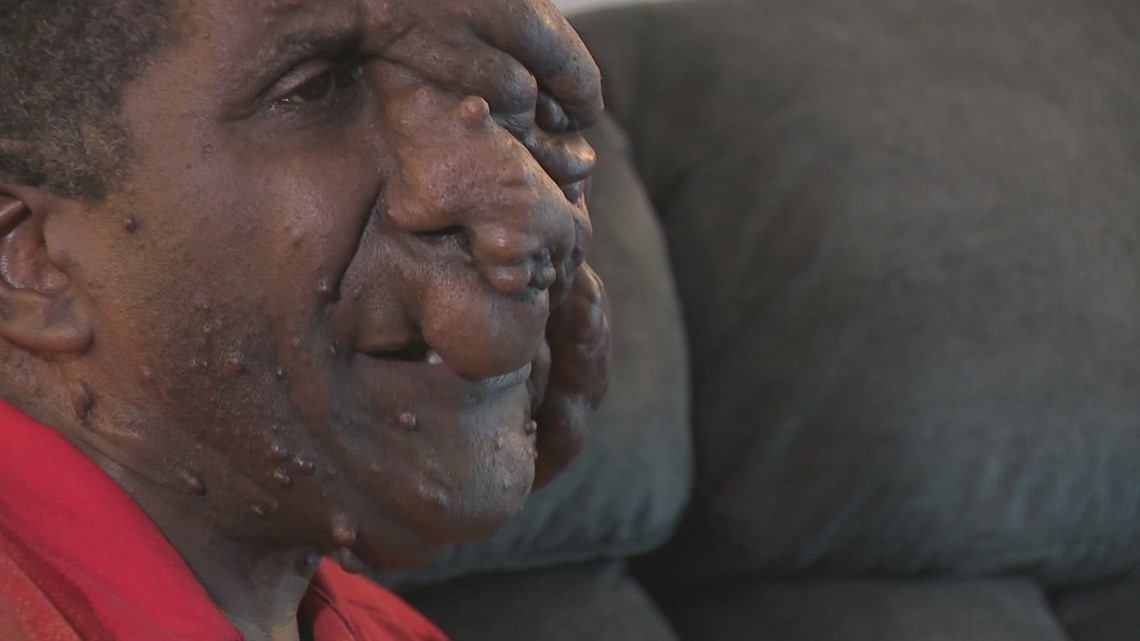 Houston man with rare genetic condition inspiring others - Vimarsana News