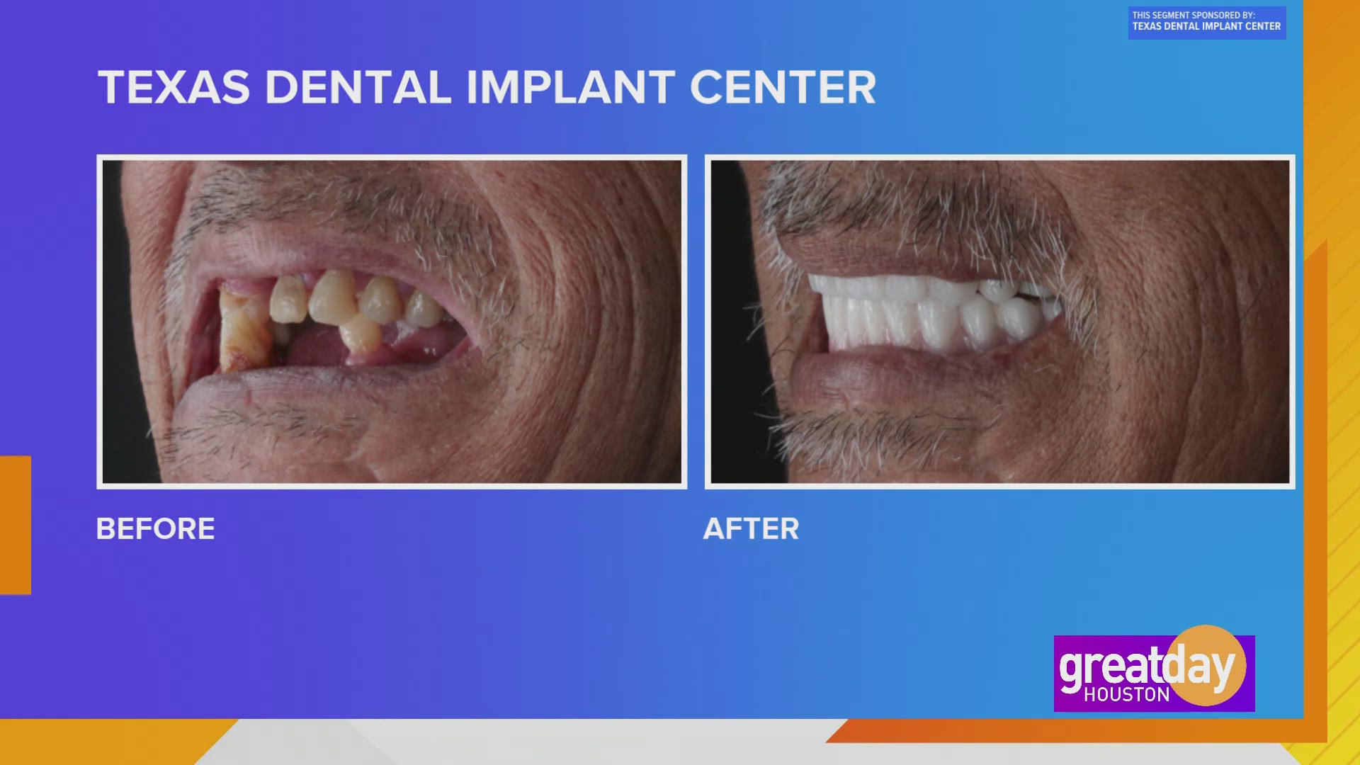 Let the Texas Dental Implant Center can give you the smile and confidence of your dreams.