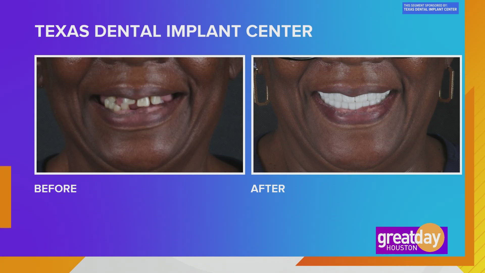 Let the Texas Dental Implant Center can give you the smile and confidence of your dreams.