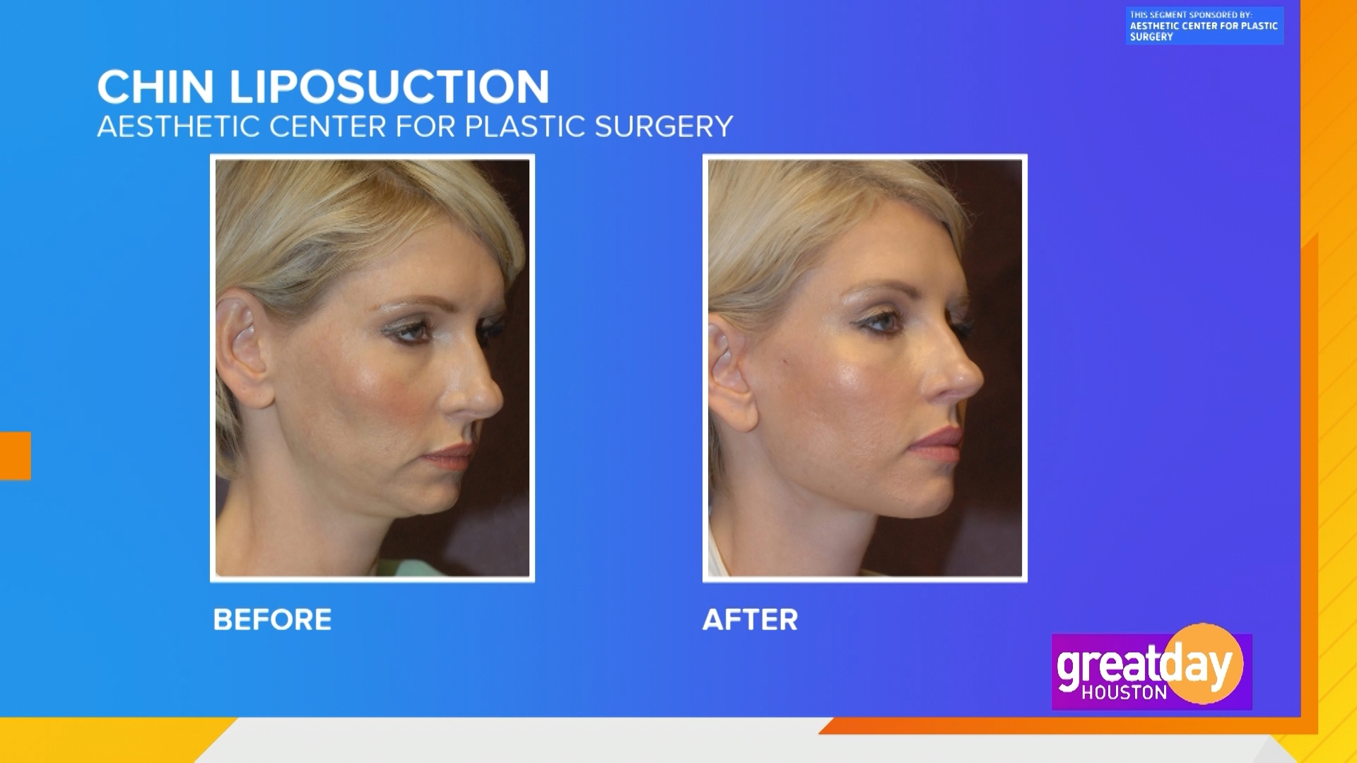 Dr. Paul Fortes from the Aesthetic Center for Plastic Surgery (ACPS) and Aesthetic Nurse Heidi Fell from ACPS MedSpa are sharing all the details on these procedures.