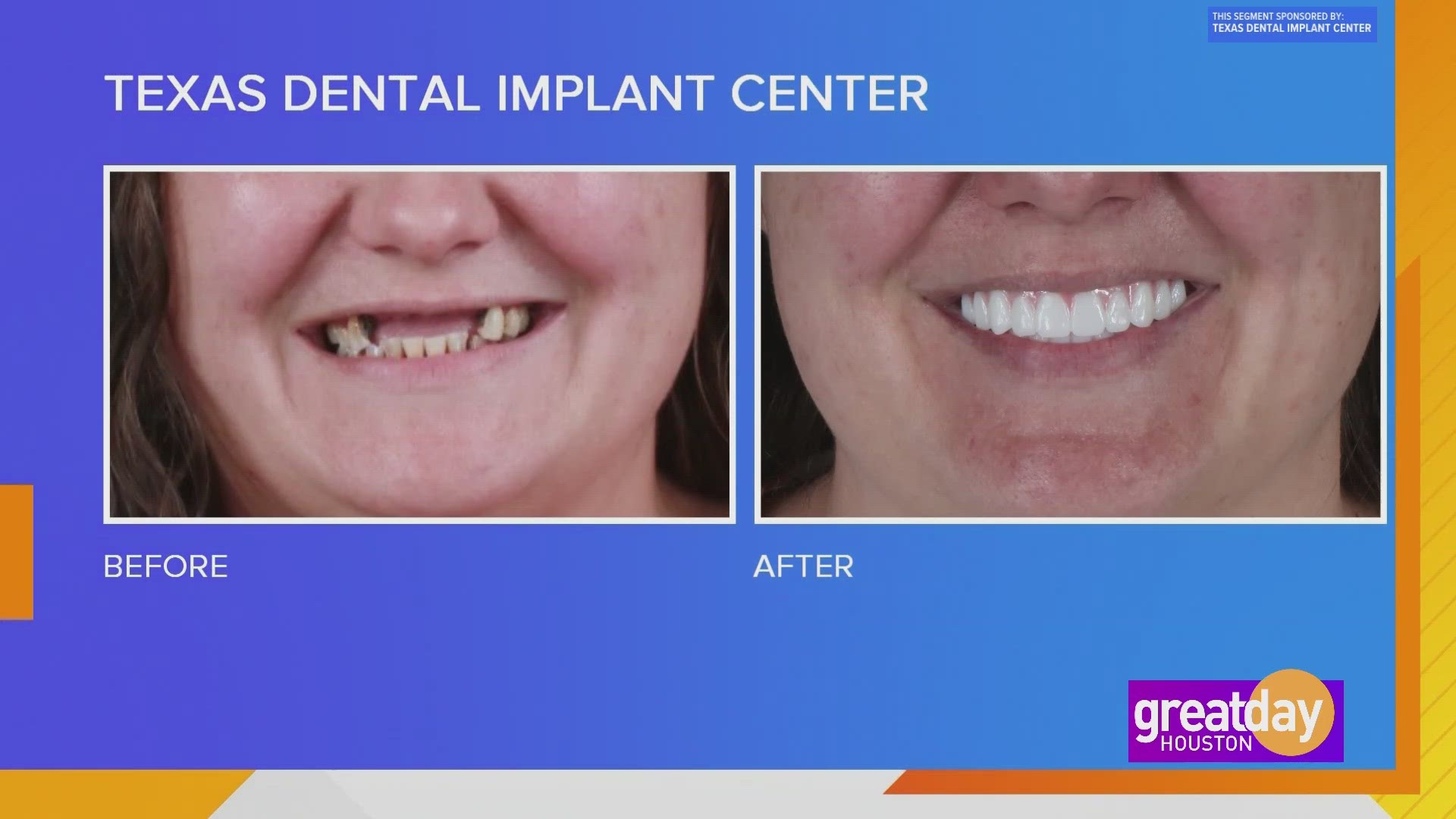 For decades, Philis Sikes battled with failing teeth. With one trip to Texas Dental Implant Center her life changed forever and yours can too!