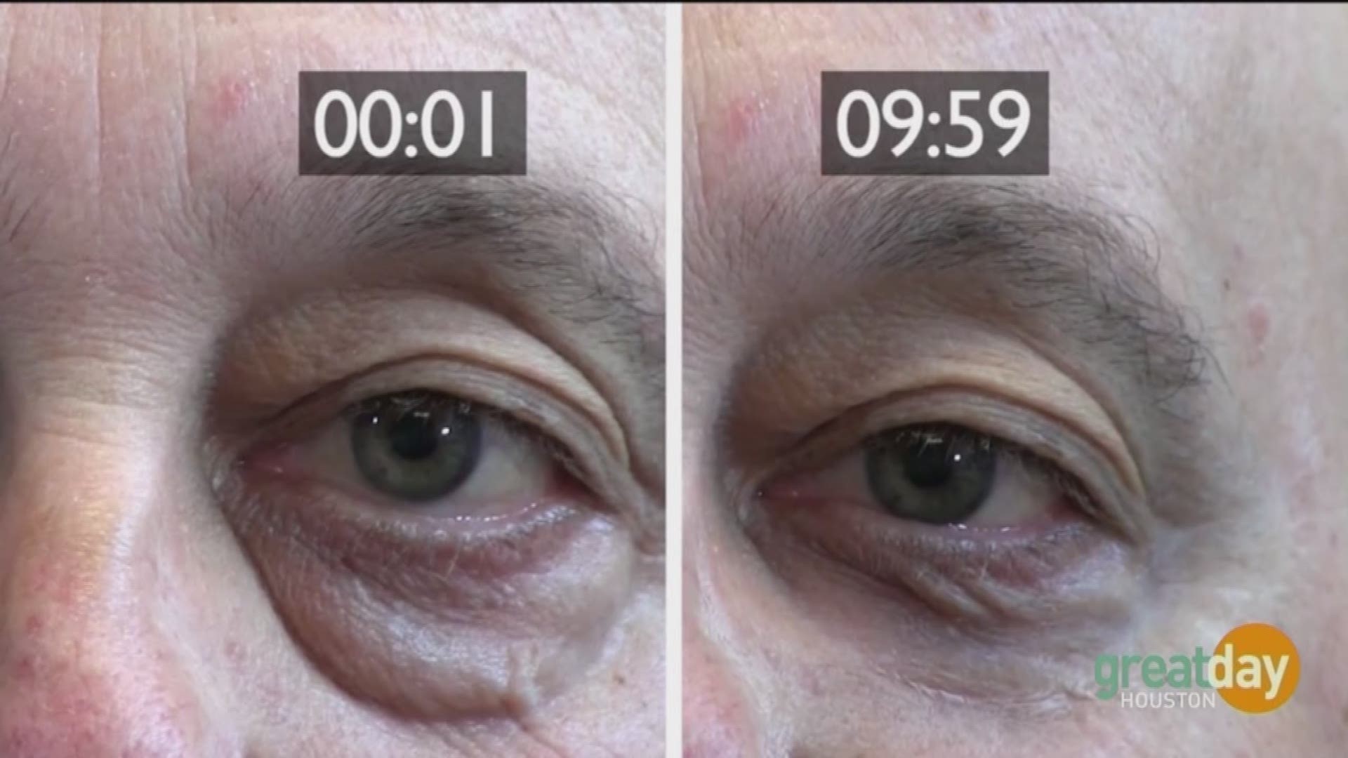 Plexaderm takes years off your face by making under eye bags and age lines disappear in just minutes.  Amy Vanderoef showed Deborah Duncan it's amazing results.