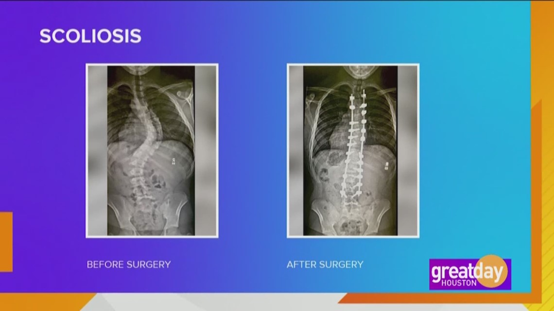 Dr. Timothy C. Borden, Orthopedic Surgeon At UT Physicians, gives fast facts on scoliosis.