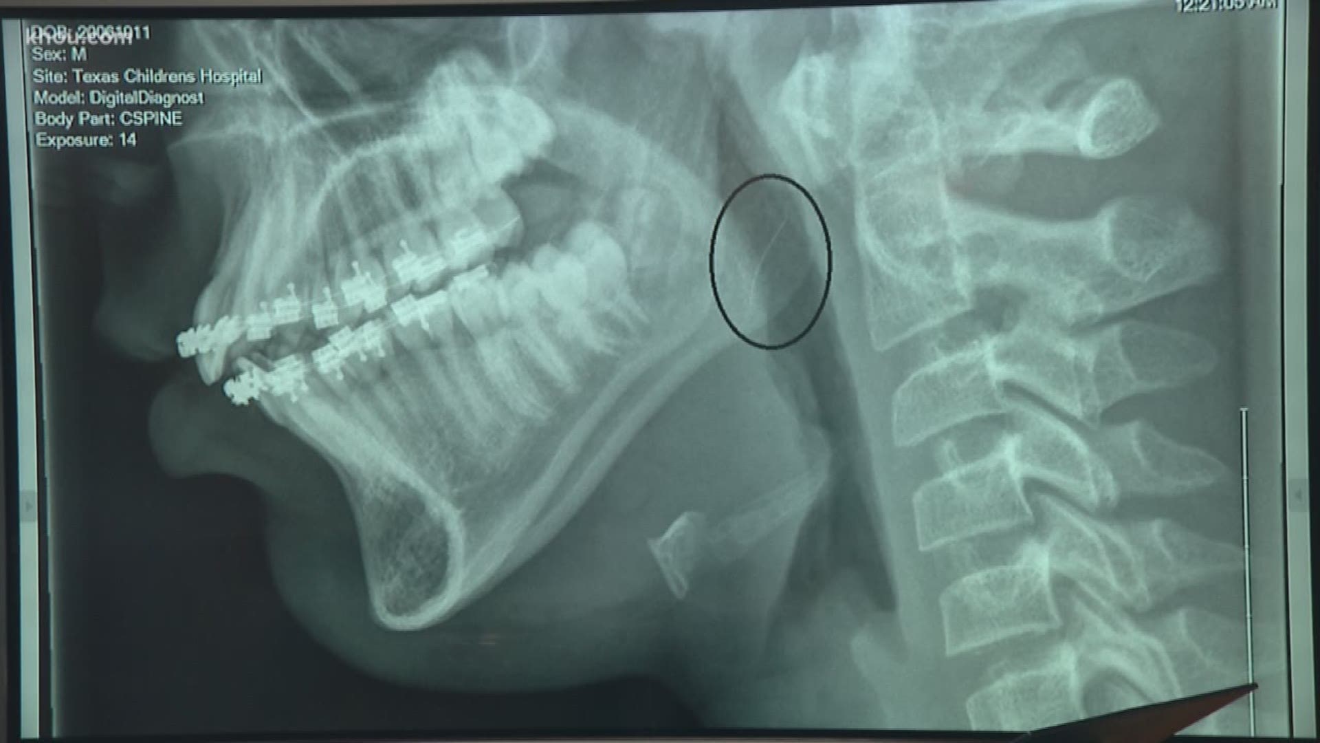 Boy swallows metal piece left from wire grill brush | khou.com