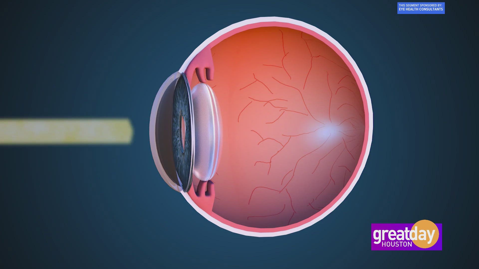 Dr. Julio Arroyo from Eye Health Consultants explains how corneal molding helps patients see clearly without glasses, daily contacts or surgery.