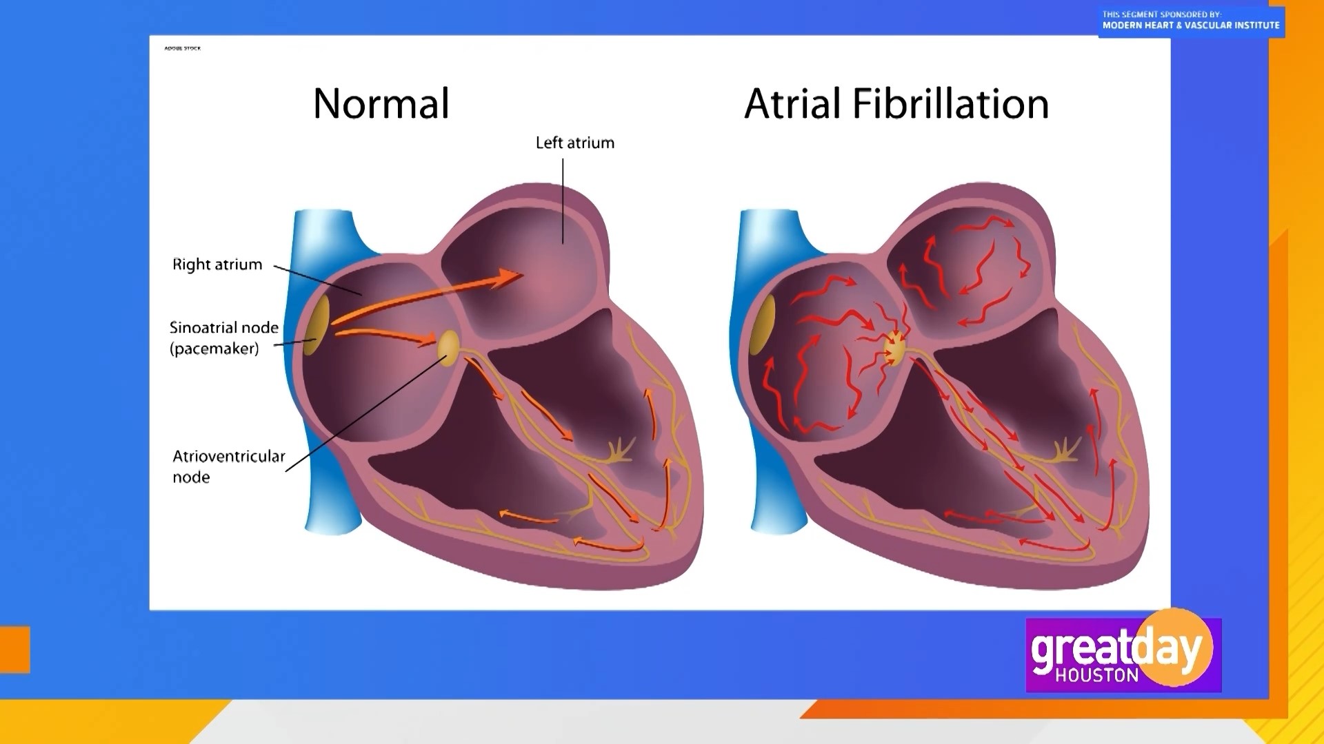 Dr. Percy Morales with Modern Heart & Vascular discusses signs, symptoms, and treatment options for Atrial Fibrillation, also known as Afib.
