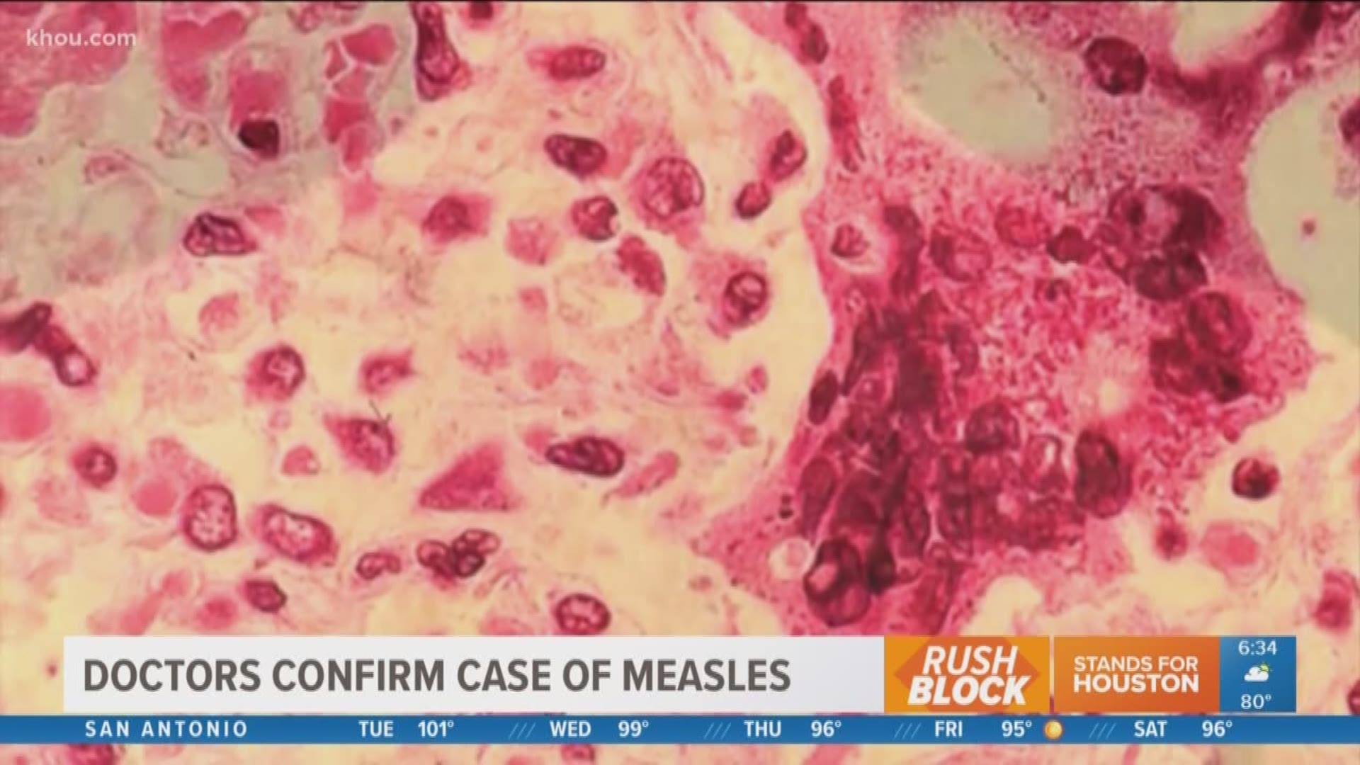 A child hospitalized with a severe fever has tested positive for the measles virus.